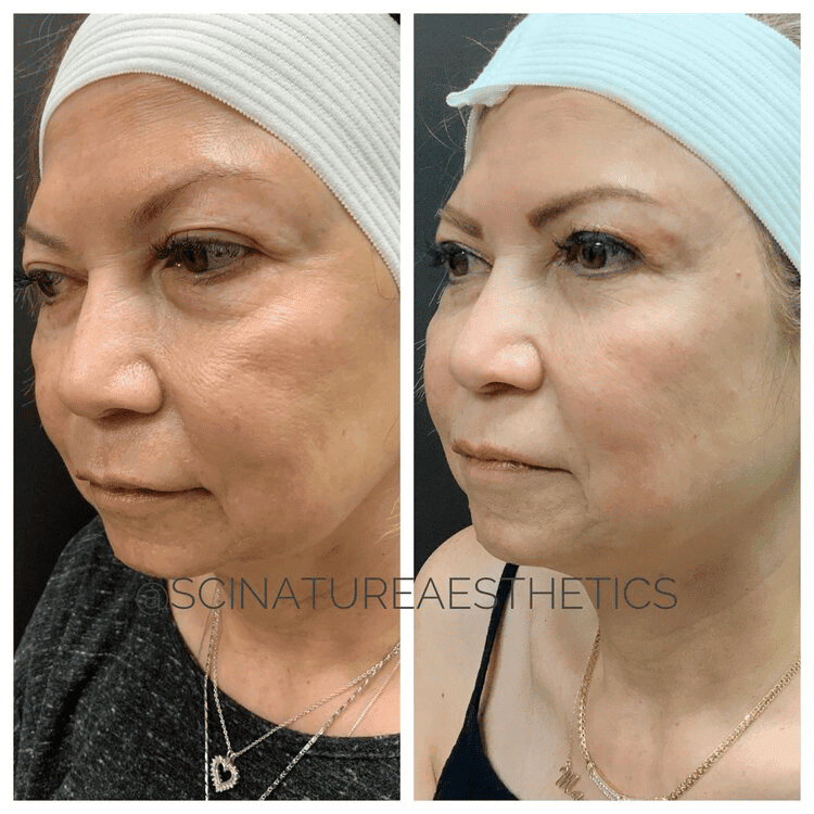 fotona 4d facelift before and after