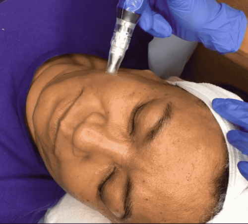 microneedling - Acne Solutions